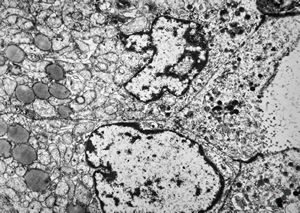 F, 73y. | follicular carcinoma of thyroid gland